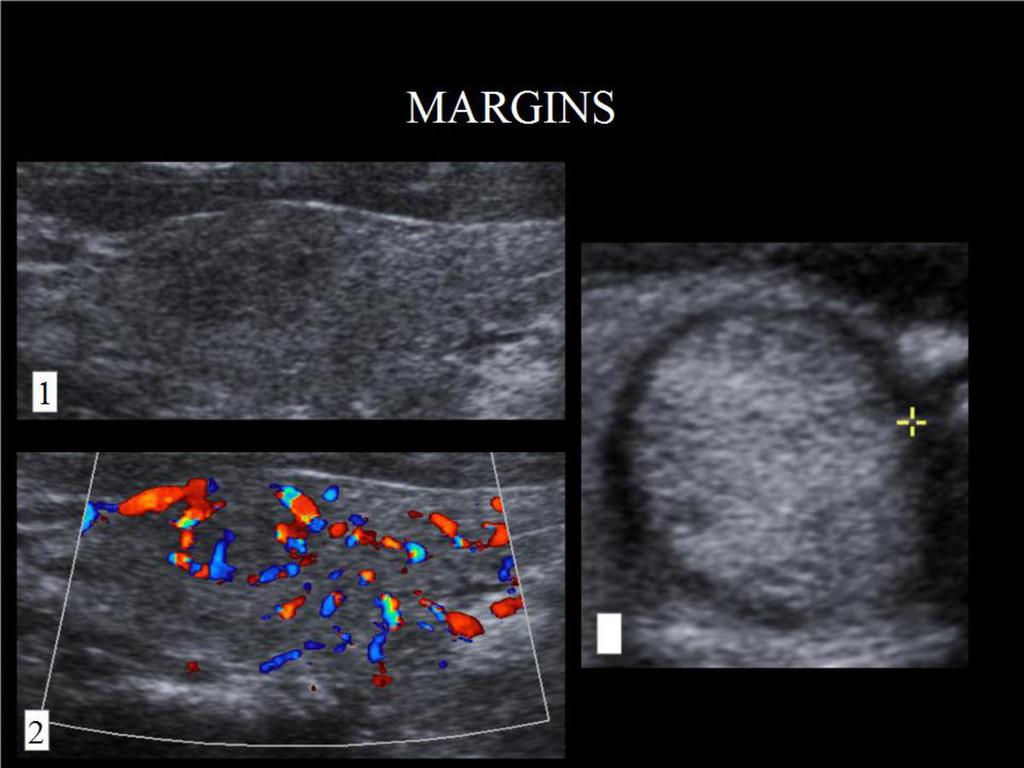 Fig. 5: MARGINS.(1) Blur margins; color doppler improves its demarcation.