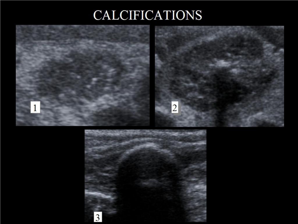 Fig. 6: CALCIFICATIONS:(1)microcalcifications depicted as tiny bright dots without posterior shadow.