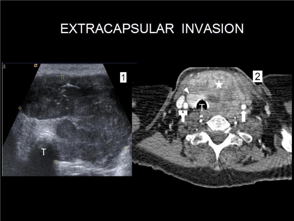 Fig. 7: EXTRACAPSULAR INVASION in anaplastic thyroid carcinoma. 80 year-old woman who suffered from airway obstruction due to a fast growing cervical mass.