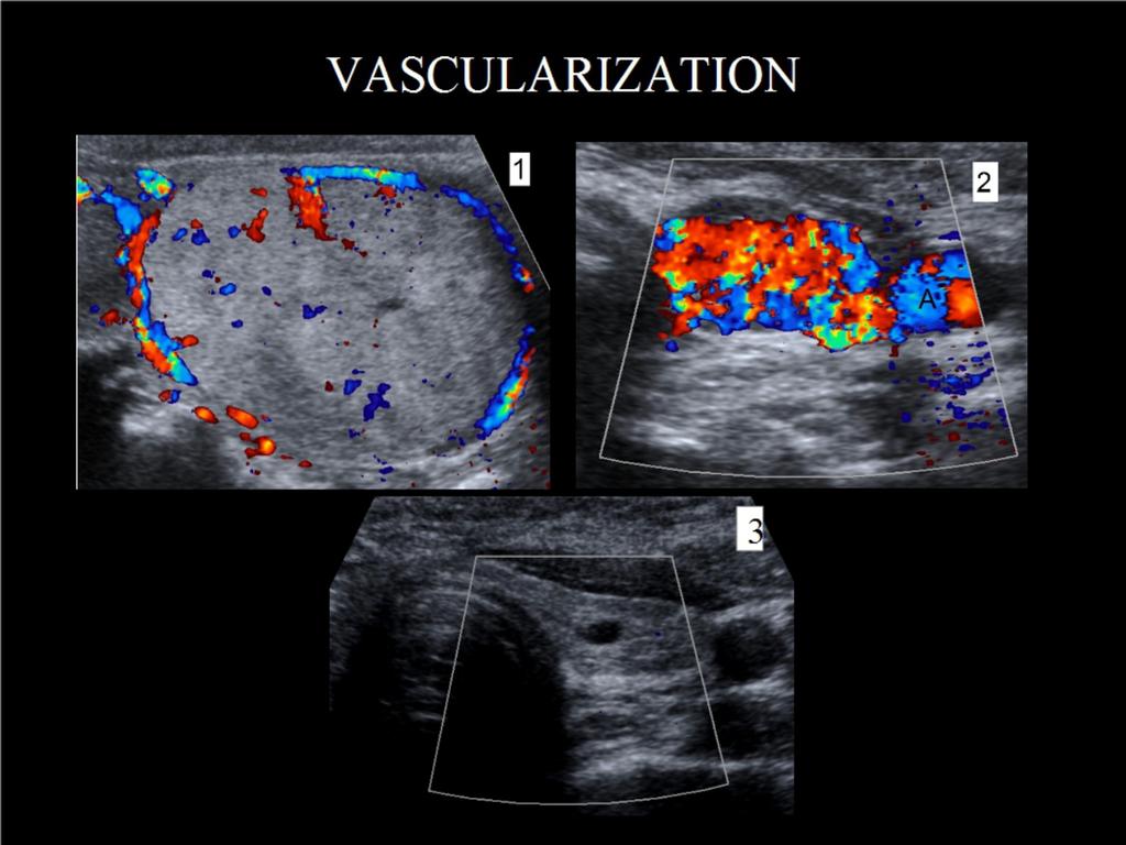 Fig. 8: VASCULARIZATION: Peripheral vascularization(1) vessels define the nodule ringlike margins.