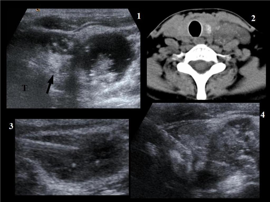 Fig. 17: PAPILLARY THYROID CARCINOMA.32 year-old woman with palpable mass.
