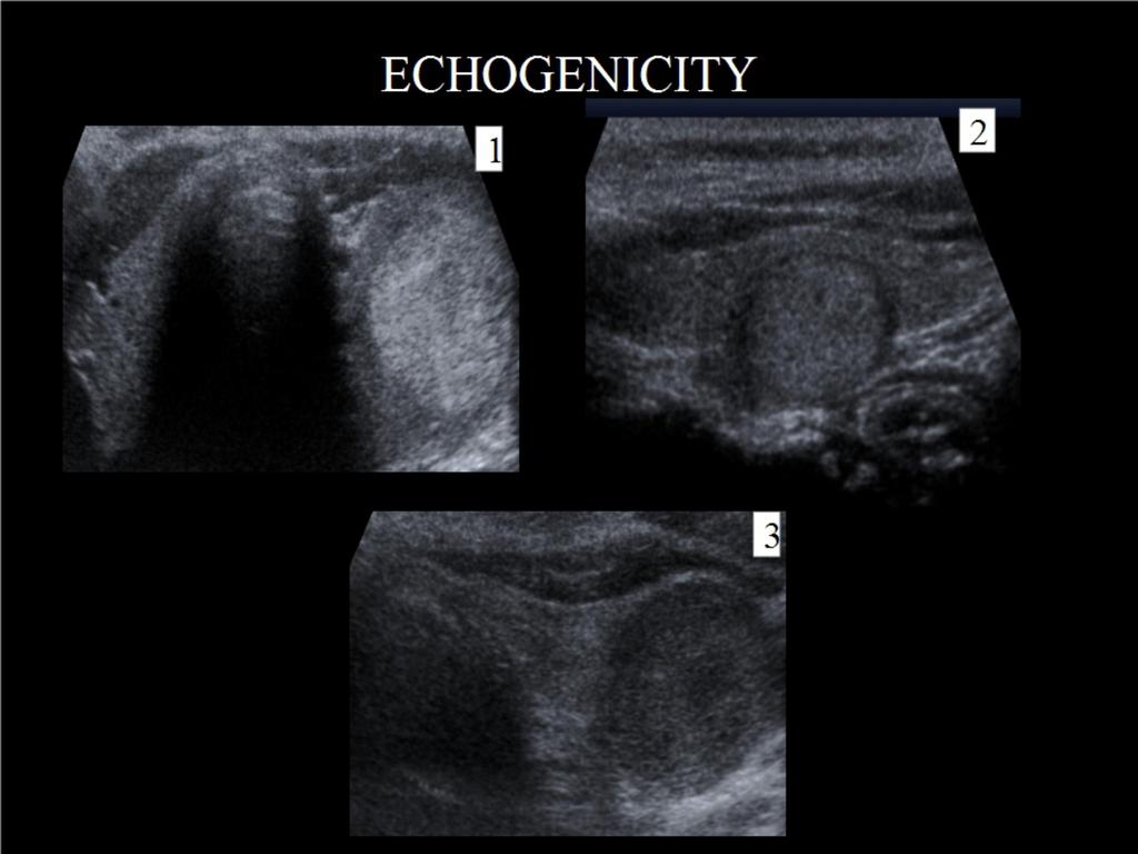 Fig. 2: ECHOGENICITY:(1)Hyperechogenic nodule compared with the surrounding thyroid parenchyma. (2)Isoechogenic nodule regarding to thyroid parenchyma.