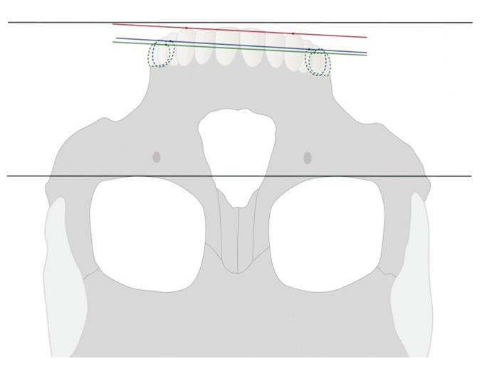 3 5). Angular measurements To measure roll (rotation around the z-axis), functional occlusal lines connecting canine cusp tips, mesiopalatal cusps of the maxillary molars, and mesiobuccal cusps of