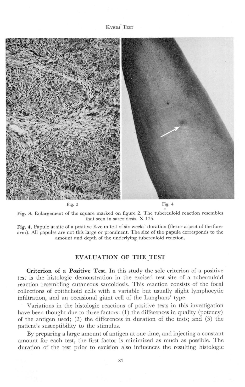 KVEIM TEST Fig. 3 Fig. 4 Fig. 3. Enlargement of the square marked on figure 2. The tuberculoid reaction resembles that seen in sarcoidosis. X 135. Fig. 4. Papule at site of a positive Kveim test of six weeks' duration (flexor aspect of the forearm).
