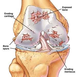 OA (wear and tear arthritis) Gradual breakdown and loss of joint cartilage; the