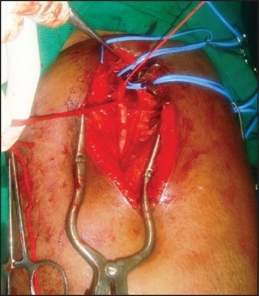 Femoral Embolectomy for Acute Limb Ischemia Incision and exposure Proximal and distal control Transverse