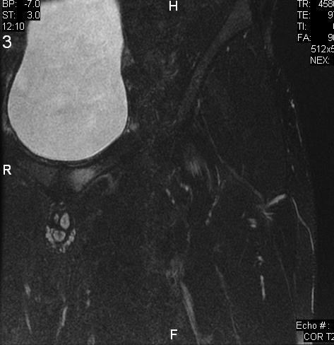 Pubic bone marrow edema during