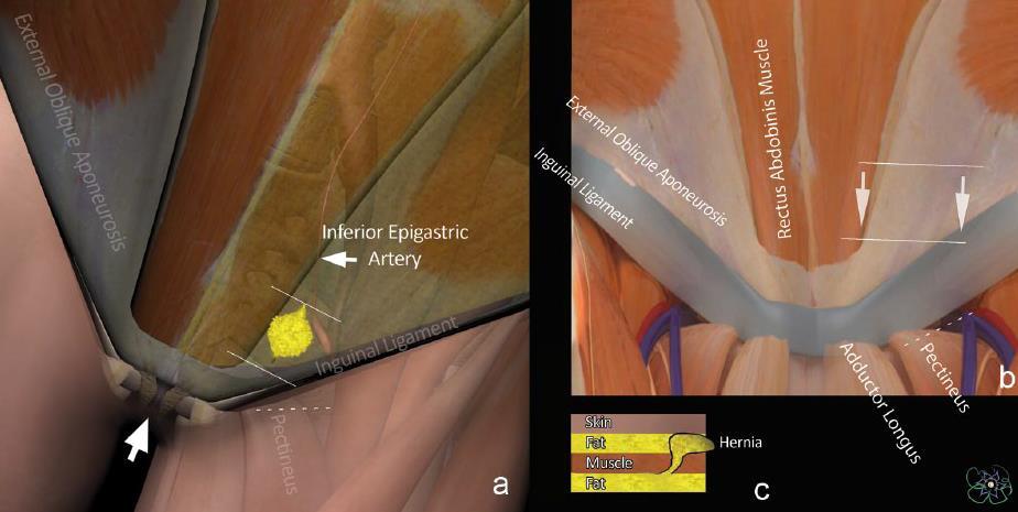 Inguinal-related groin pain Imaging