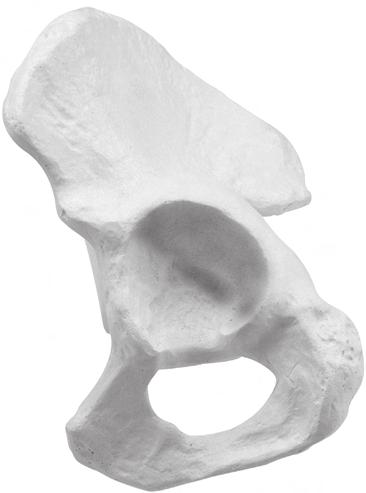 Zimmer Continuum Acetabular System Surgical Technique 7 With the Implant in the appropriate position and alignment, use a mallet to impact the handle of the Inserter.
