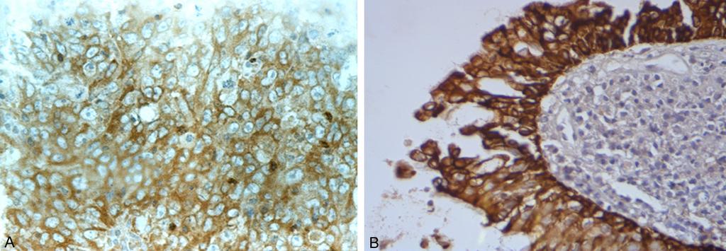 Figure 1. c-met expression in the membrane and/or cytoplasm of NPC cells (A) and controls (B), stained brown (400 ). Figure 2.