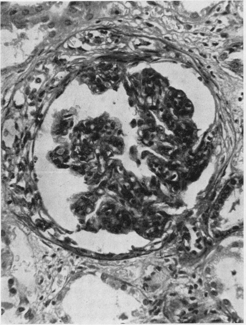 Microscopically a diffuse nephritis, suggestive of type 1, was found in three cases (Fig.