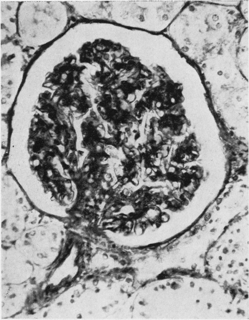 FIG. 7. Proliferative glomerulitis with 'lobulation' of tuft.