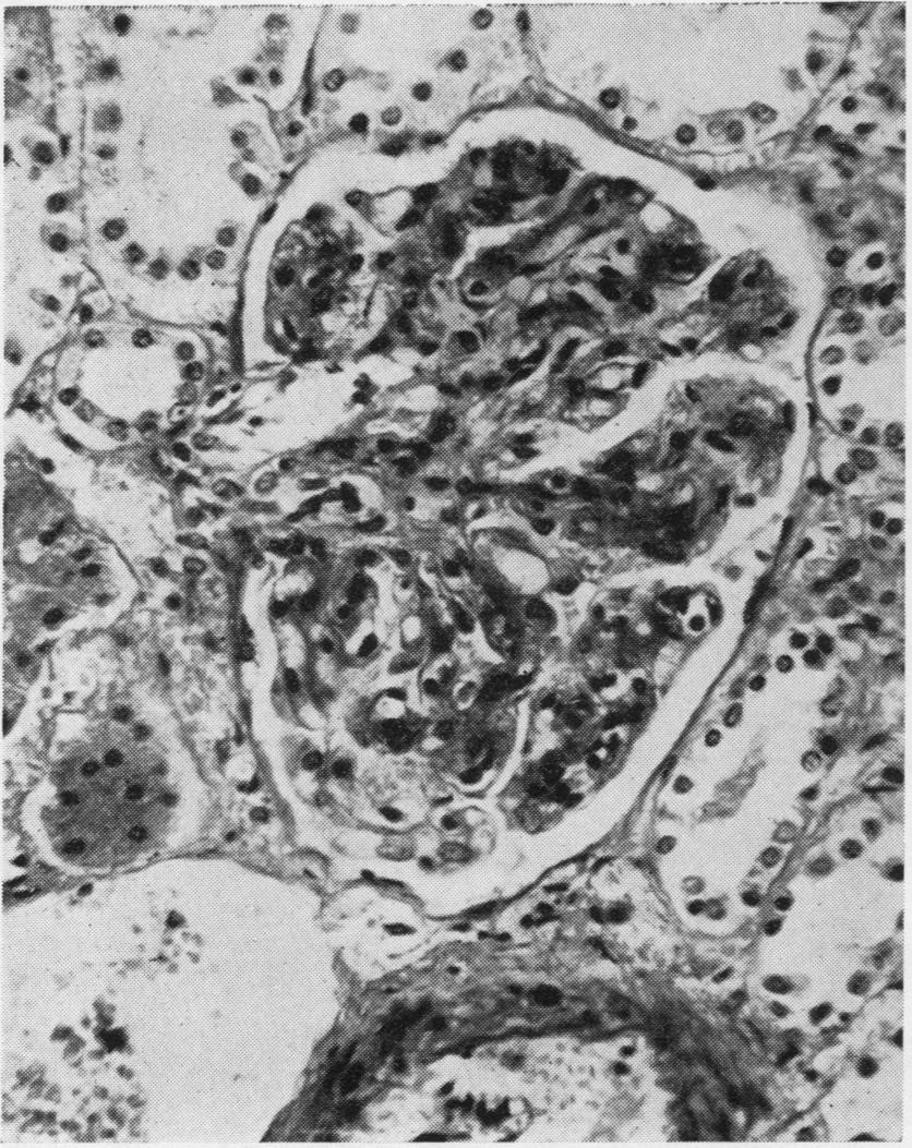 8. Proliferative glomerulitis; preominanly thd3;hickigo baement memburaes.