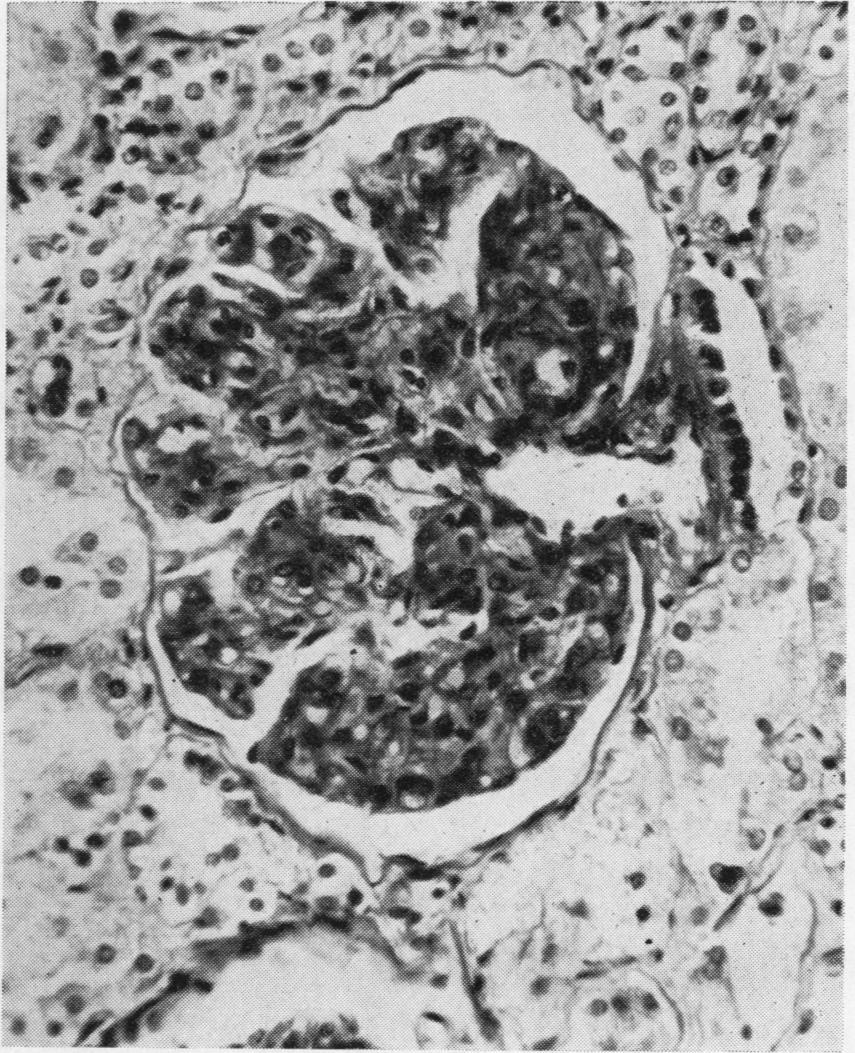 Prolifnerative glomerulitis wt lblto'ouf. From fema37 aged le with chronic mitrl vlvu itis. PnoS x vi290.