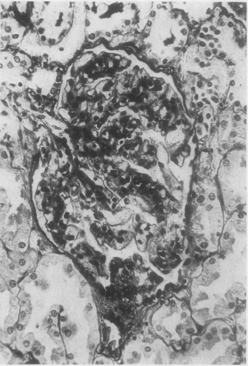 418 l."" FIG. 10 W Dorothy S. Russell FIG. 10. Proliferative glomerulitis with adhesions. Hyaline droplet degeneration was found in capsular epithelium.