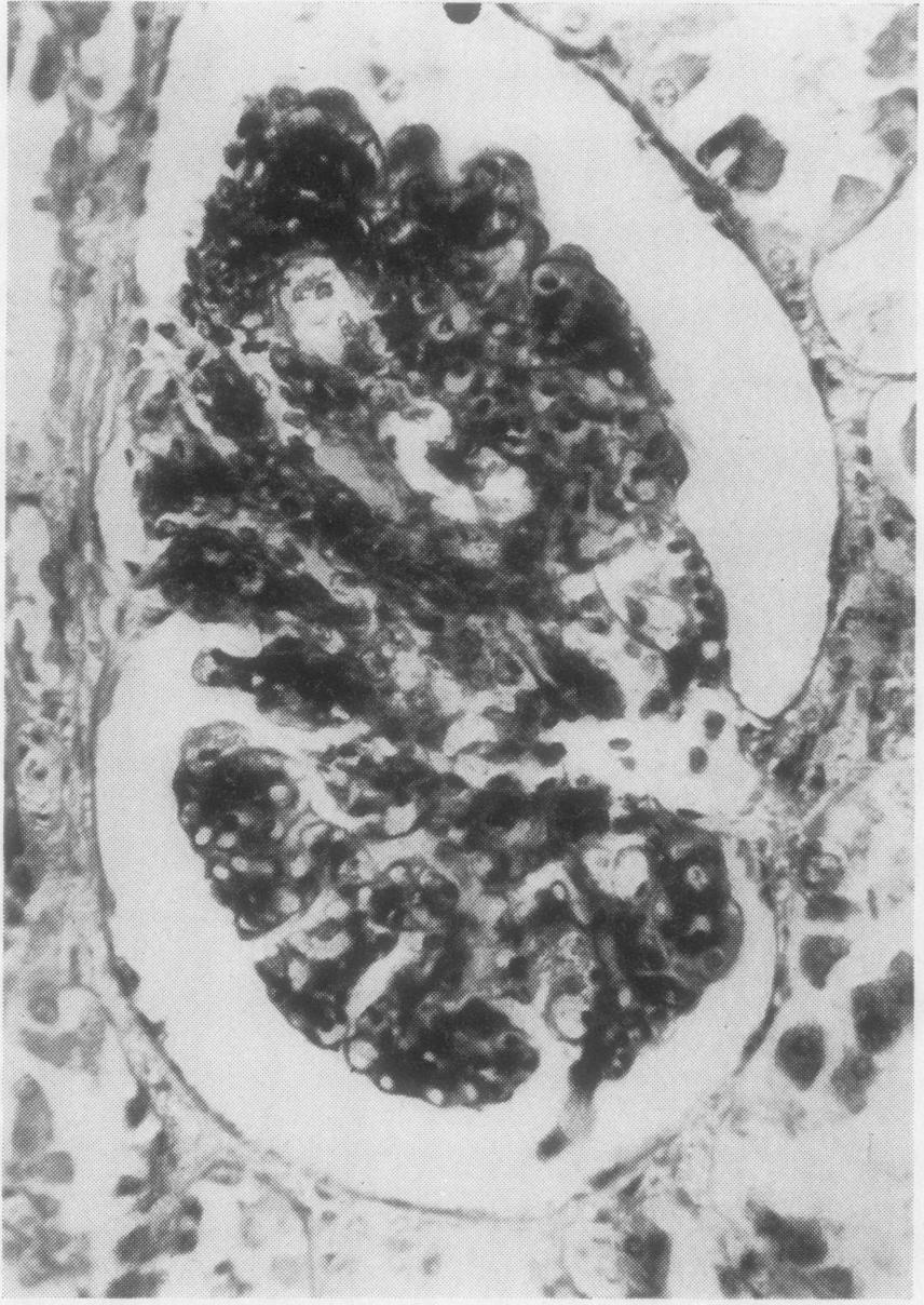 ADDITIONAL GLOMERULAR CHANGES In 39 examples of this group the glomeruli also showed adhesions of the tuft to the capsule (Figs.