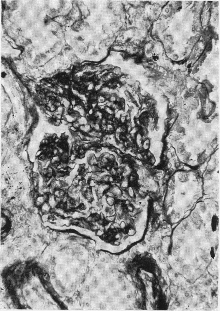of Cases Proliferative glomerulitis alone 33 Proliferative glomerulitis with increase of interstitial tissue 4 Proliferative glomerulitis with increase of interstitial tissue and focal necroses 8