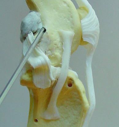 The fascia is elevated from its insertion on the tibial crest to allow lateral reflection of the fascia and greater exposure of the structures in this area.
