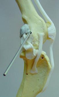 Once the drill bit has entered the cortex of the lateral femoral condyle the drill is re-directed to create a bone tunnel that emerges more proximally