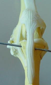 Placing the tunnel at Gerdy s tubercle (just cranial to the fossa of the long digital extensor tendon) avoids damage to the tendon at the time of
