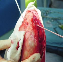 The needle emerges under the medial gastrocnemius muscle belly in the space previously cleared. The prosthesis is drawn through the femoral tunnel.