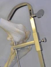 6 Finish and close The entire surgical site is flushed thoroughly. The fascia is closed over the medial tibia with interrupted or continuous sutures of an absorbable monofilament material such as PDS.