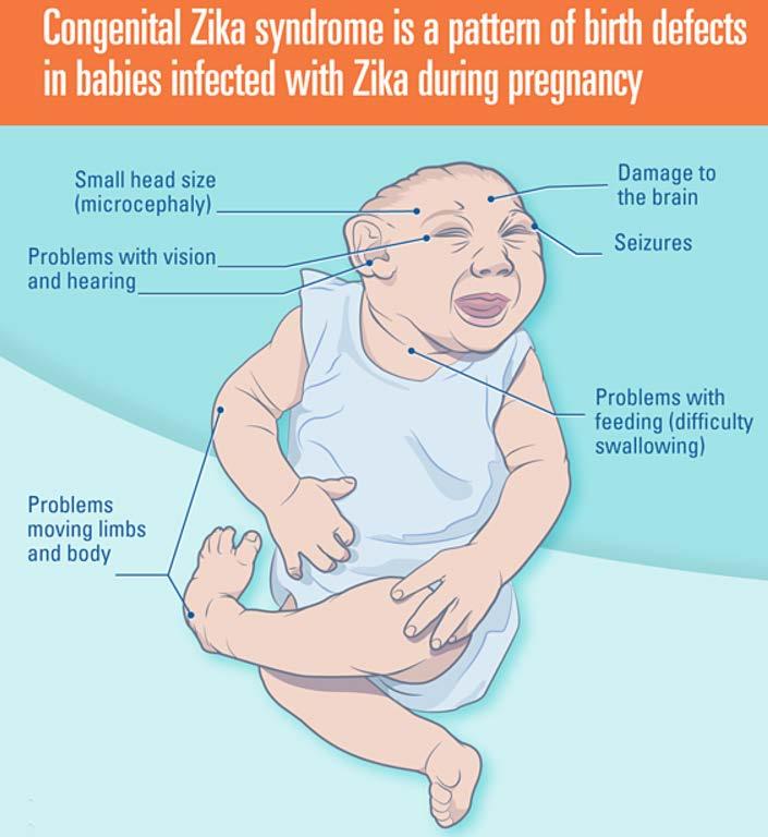 Congenital Zika Syndrome Syndrome of severe birth defects associated with congenital Zika virus infection
