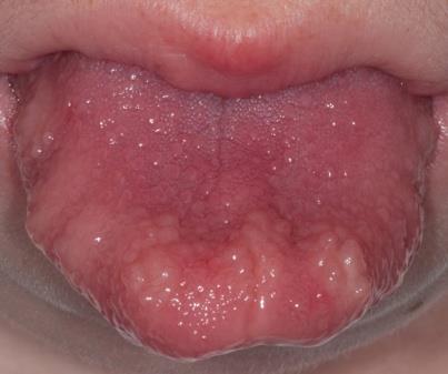 MEN2B Phenotype Megacolon Thickened lips and mucosal