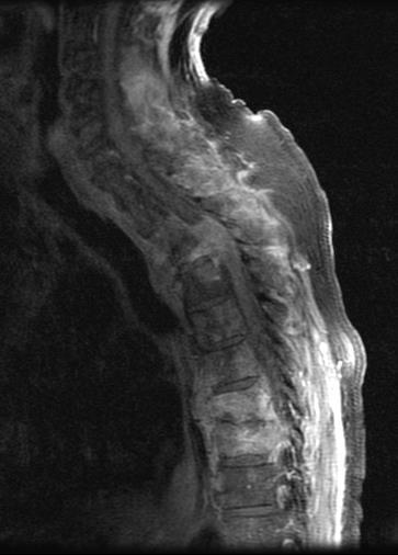 Bone Metastases Spinal Met with Cord