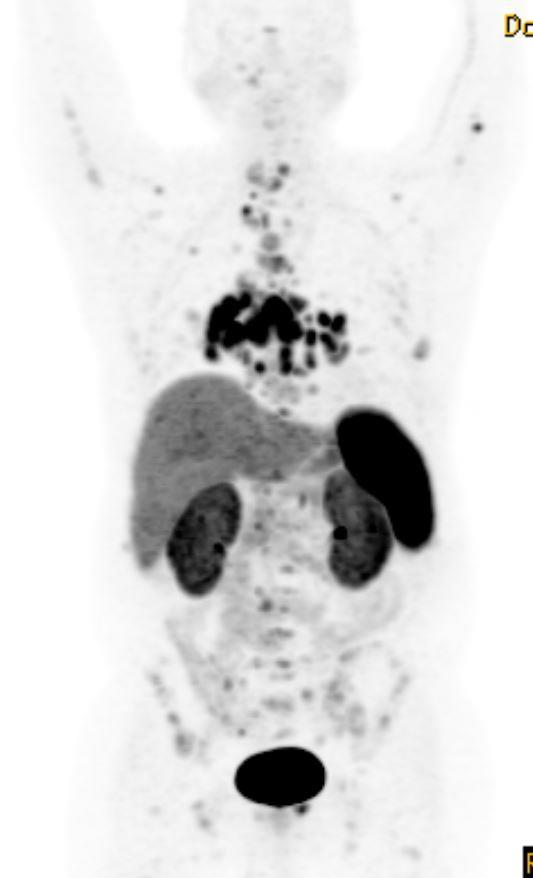 68 Gallium Dotatate PET/CT Improved detection rate compared with 111 In-octreotide SPECT/CT