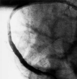February 1998 43 very flexible, thus offering side branch access. The low profile of the stent favorably influences the handling characteristics.