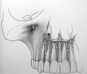 Maxillary Anesthesia Clinical Considerations: Infiltration effective Less