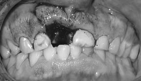Irrigate Tooth 2. Local Anesthetic 3.