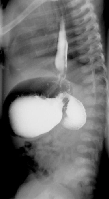 Fig. 9: Gastroduodenal barium study in a patient with duodenal stenosis.