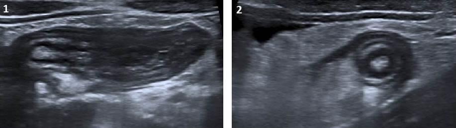 Fig. 10: Acute appendicitis with target sign.