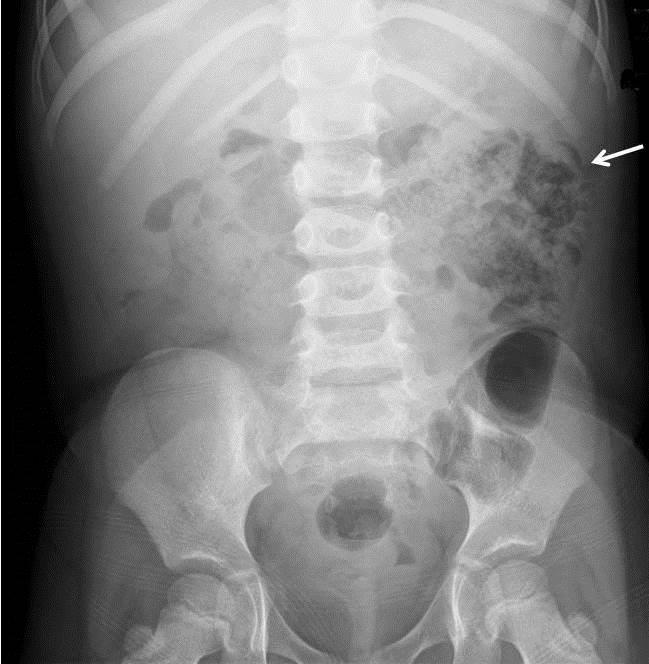 Fig. 1: Intestinal malrotation: 1. Abdominal x-ray of a patient with history of bilious vomiting.