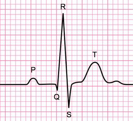 The ECG Single unit represents a heart beat Recorded on grid paper Height= amplitude Measured