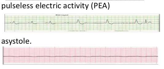 Pulseless Electrical Activity and Asystole Person is