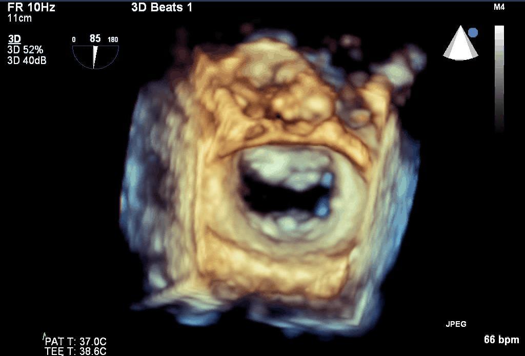 Real Time 3-D Imaging of Mitral Valve Aorta =