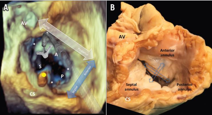 Orientation in the right atrium for TV interventions SURGICAL VIEW OF THE