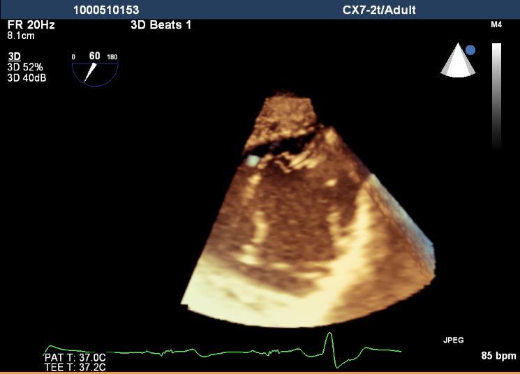 Tricuspid Valve: 3-D from transgastric short axis Posterior Septal
