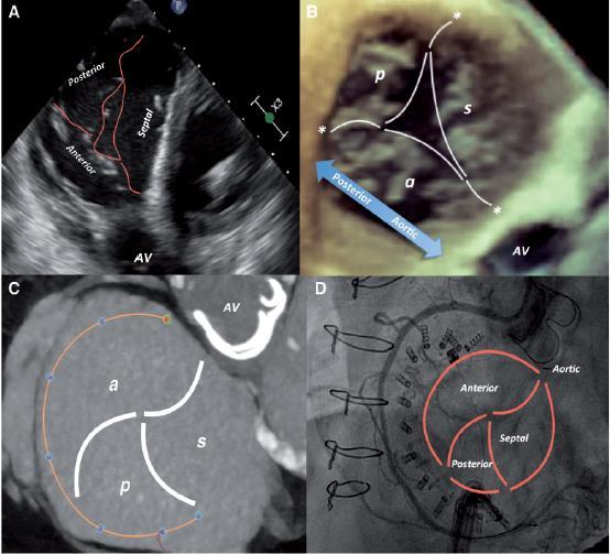 Multimodality Tricuspid Valve Imaging TEE -TRANSGASTRIC SHORT AXIS VIEW 3D-TEE MID-ESOPHAGEAL VIEW