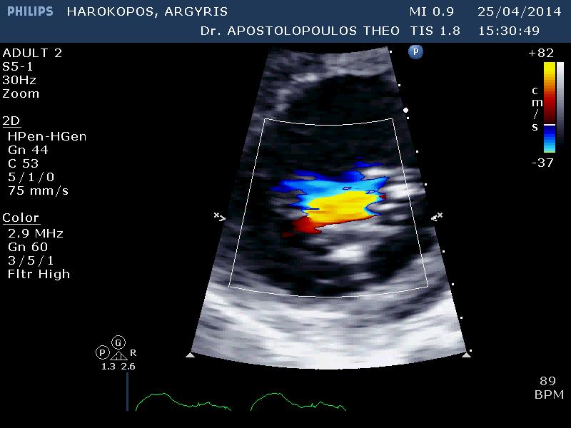 Transthoracic MV Interrogation: Parasternal short axis at base with Color Flow Doppler Localization of