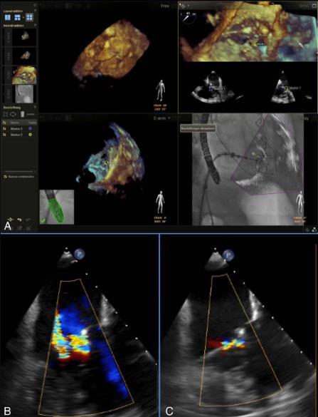 Fusion Imaging (3D-Echo with Fluoroscopy) for Edge-to-Edge repair with