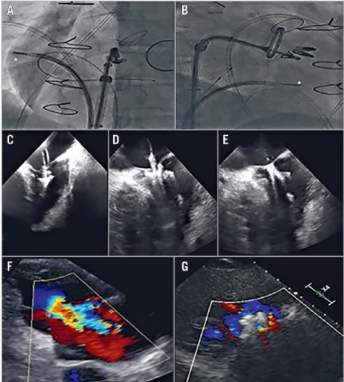 Intra-cardiac Echo (ICE) for Tricuspid Edge-to-Edge Local anesthesia SGC via right femoral vein 10 Fr ViewFlex Xtra ICE probe (St.