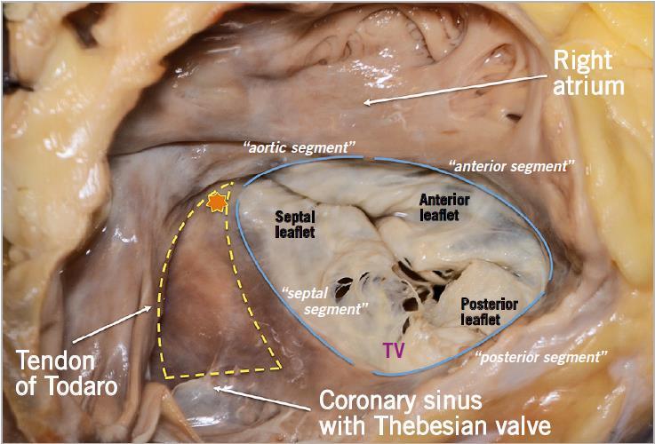 Tricuspid valve annulus Largest orifice of all valves 7-9cm 2 Contiguity with Koch triangle, RCA (anteroposterior) and aortic cusps Annulus attached to