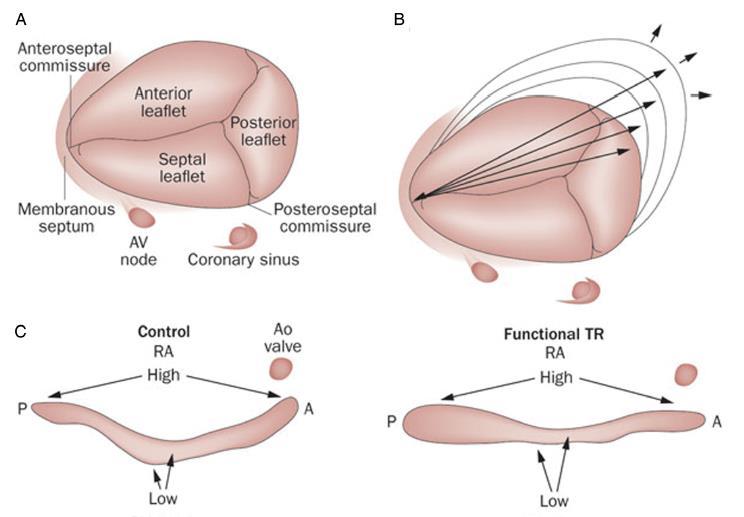 Changes in Anatomy of the Tricuspid Valve in