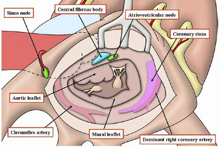 Mitral Valve and Adjacent Structures AV node Coronary sinus Left