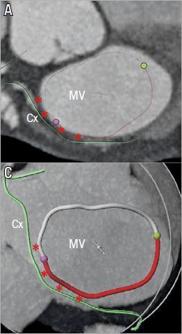 annuloplasty procedures Mitral annulus in proximity with the left circumflex In the