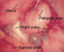 FIGURE 3. Cystic implants adjacent to the right ovary; note bluish appearance. FIGURE 5. Ovary with endometrioma.